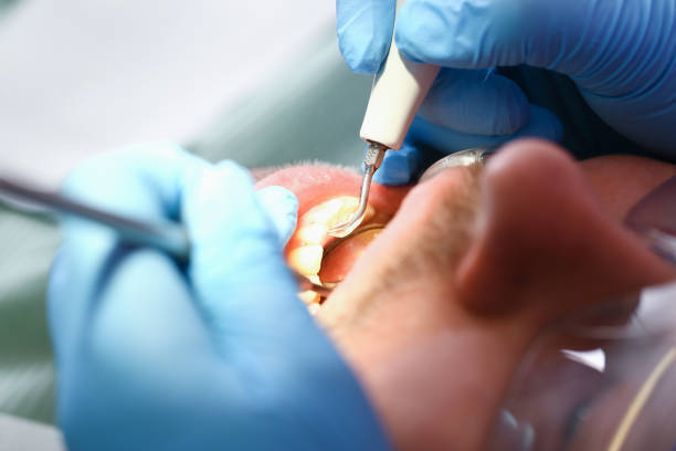 Best Emergency Wisdom Teeth Removal in Lake Bryan, TX